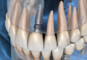 Model of dental implant replacing upper tooth